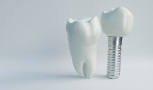 dentarios